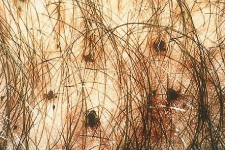 Kihalhat a lapostetű a szőrtelenítés miatt